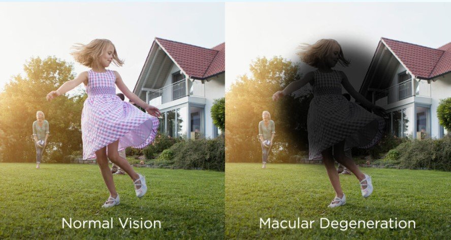 Macular Degeneration Thumbnail
